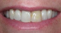 discoloured tooth before dental veneer placement in Hereford