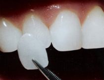 Dental veneer placement in Hereford