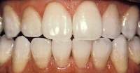 Photo of the mouth after professional teeth whitening in Hereford