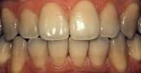 Photo of the mouth before professional teeth whitening in Hereford