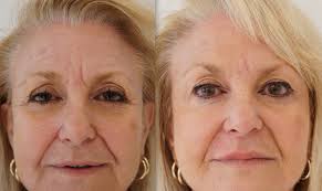 Before and After photo of Botox results in Hereford