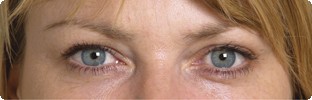 After Botox results on crows feet in Hereford