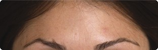 After Botox results on forehead lines in Hereford