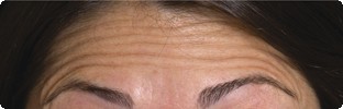 Forehead lines before Botox in Hereford