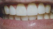 chipped teeth repaired after dental veneer placement in Hereford