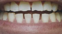 chipped teeth before dental veneer placement in Hereford