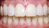gaps between teeth closed after dental veneer placement in Hereford