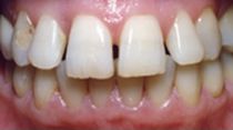 gaps between teeth before dental veneer placement in Hereford