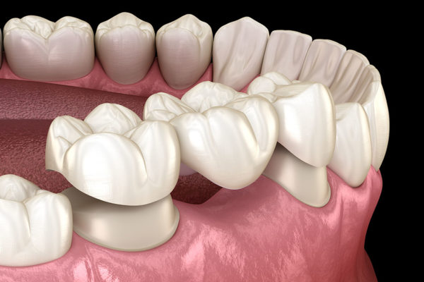 What are dental bridges?