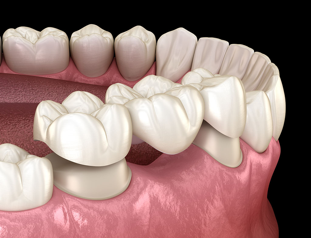 What are dental bridges? - Willows Dentistry