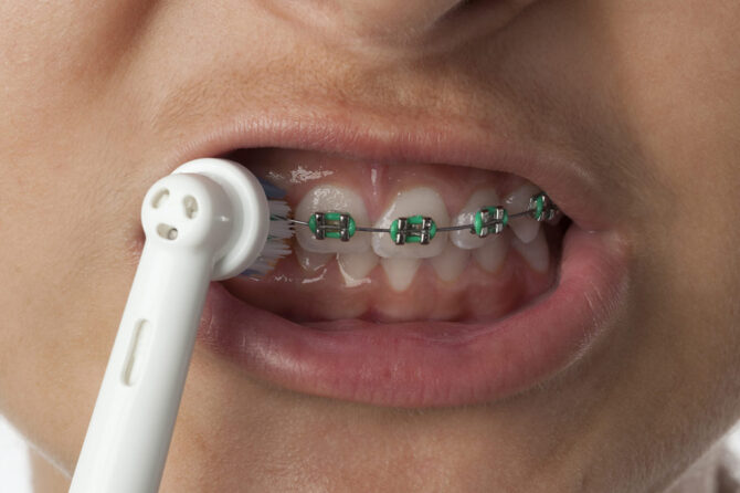 How to keep your teeth clean with braces