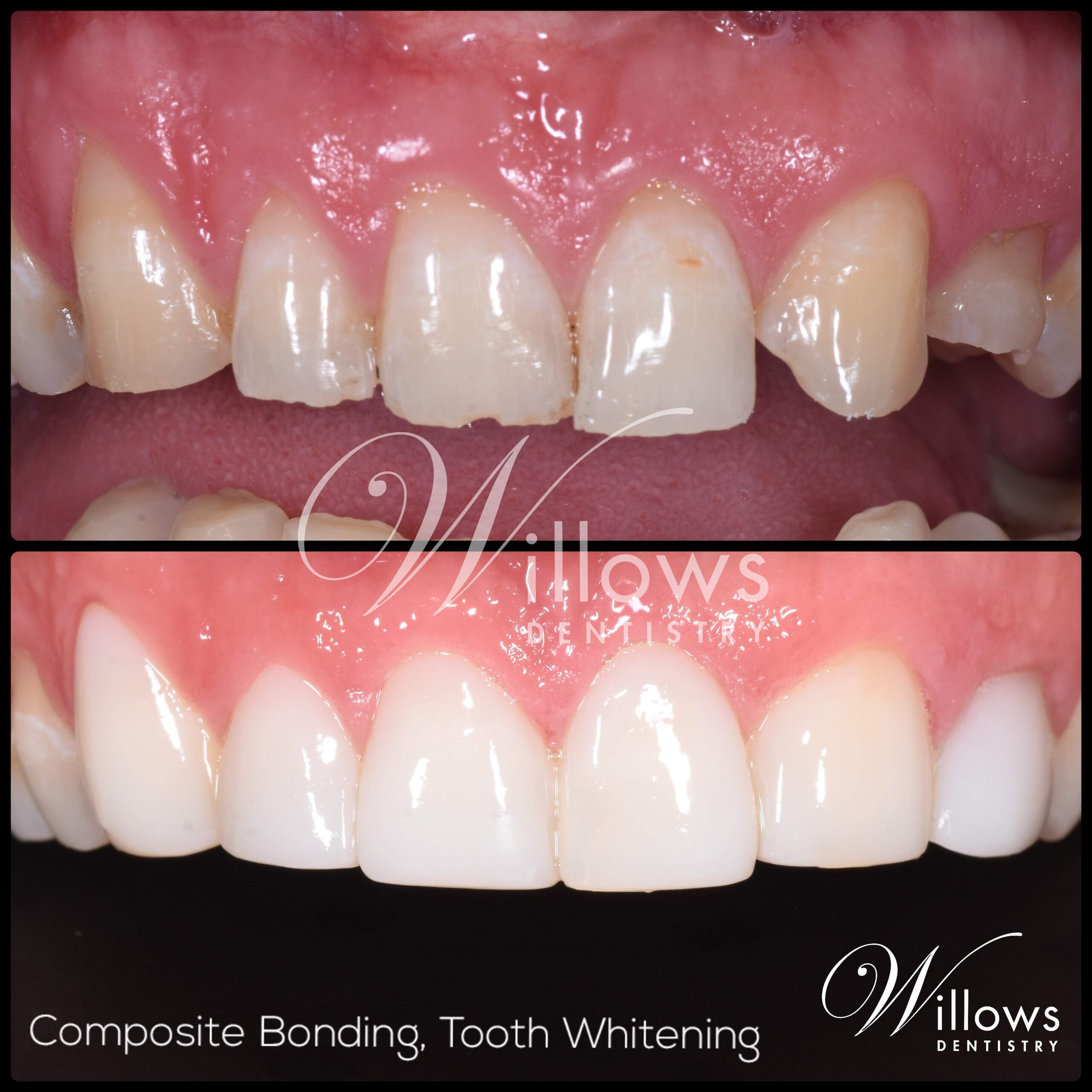 Composite Bonding Willows Dentistry